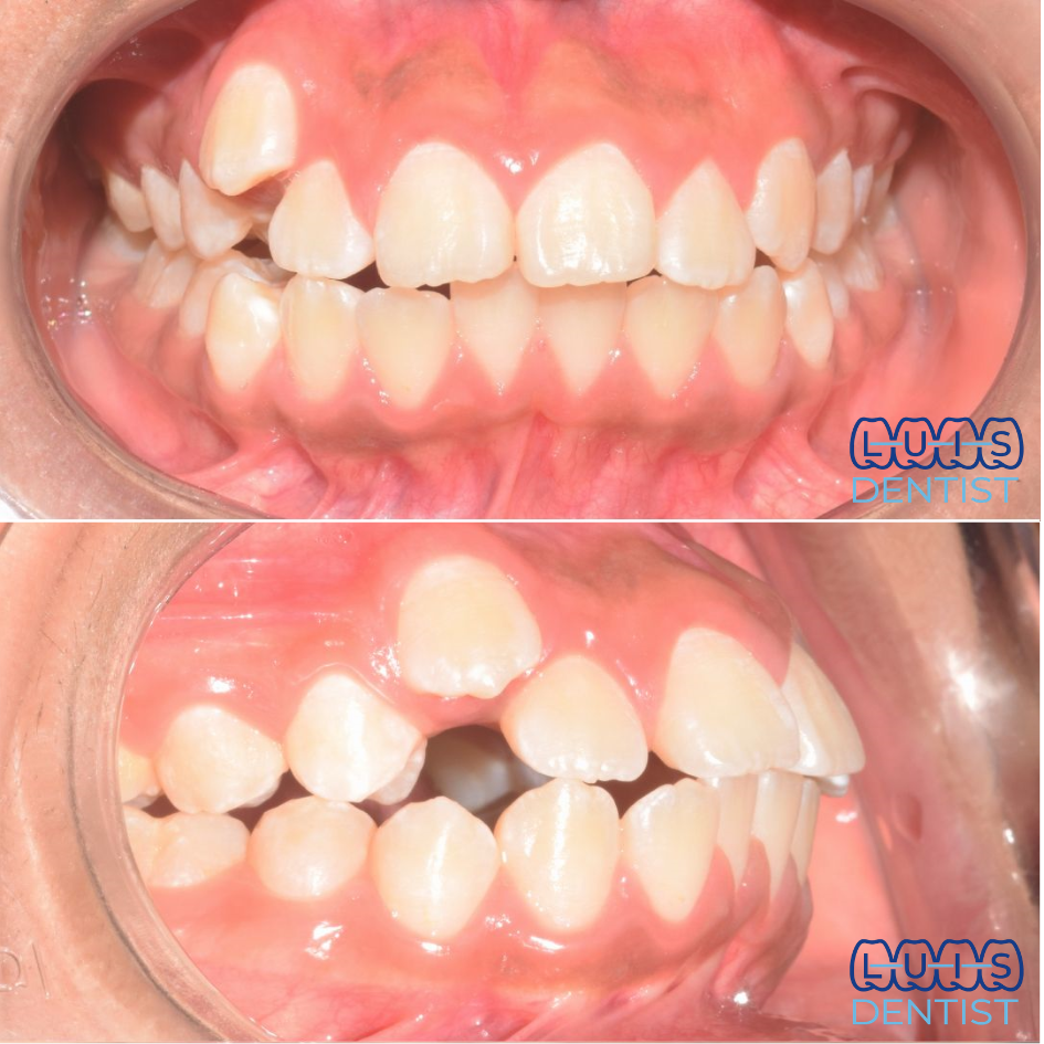 Antes - Ortodoncia - Biprotrusion
