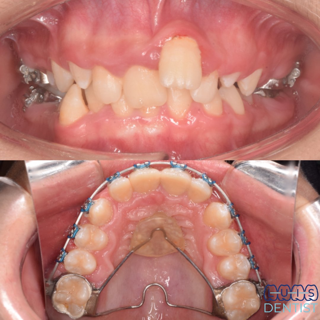 Antes - 2da Molar impactada