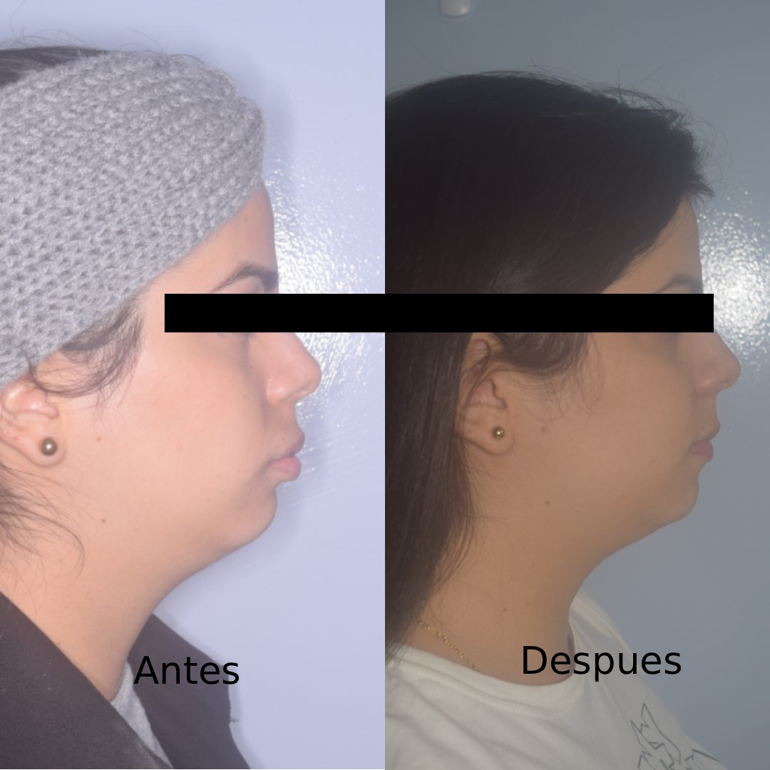 Durante - Ortodoncia - Clase II