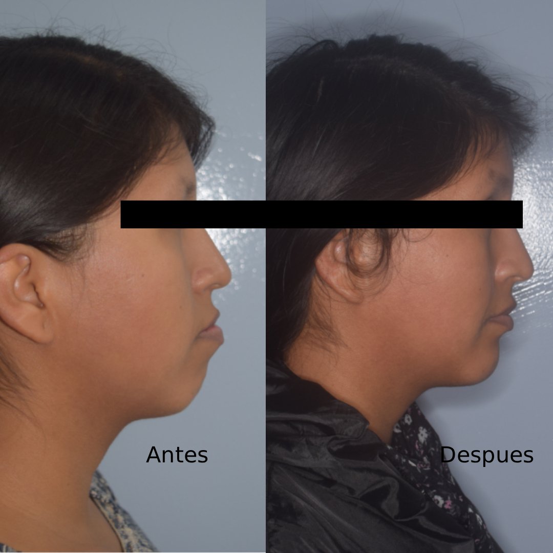 Durante - Ortodoncia - Biprotrusion