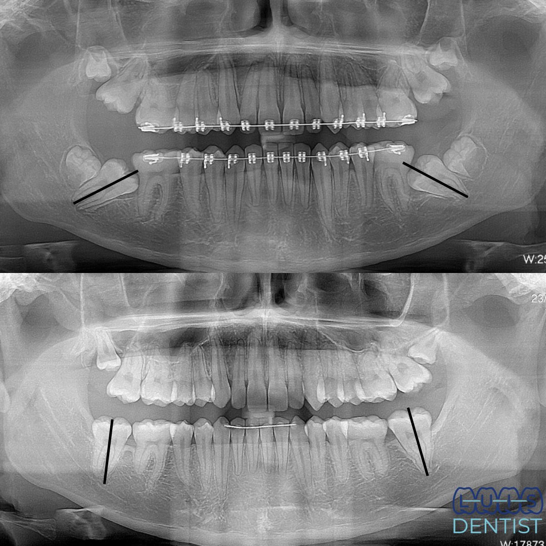 Durante - 2da Molar impactada